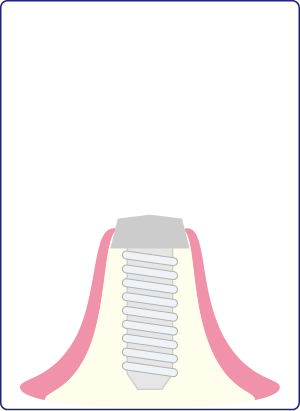 インプラント体埋入のイラスト
